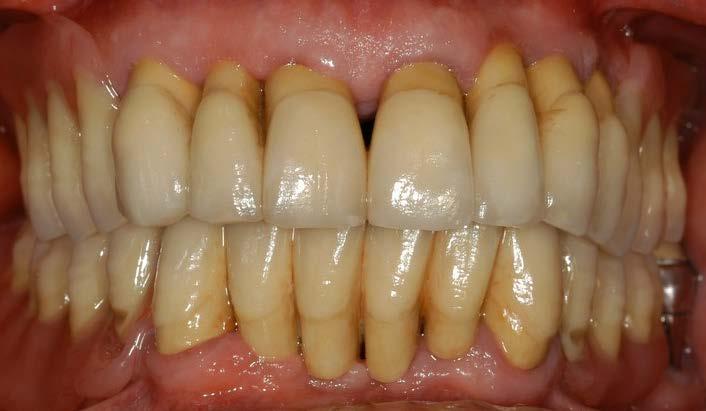 A destra: la terapia parodontale ha salvato dall estrazione nell arcata superiore ben 5 denti,
