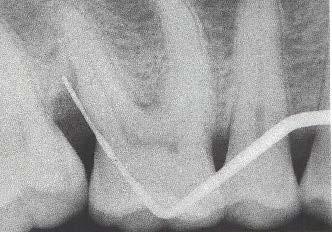 La radiografia conferma la tasca parodontale: parodontite. Cura della parodontite iniziale/moderata. 1.