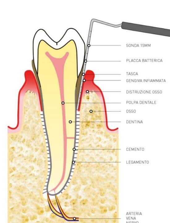 Nei casi 1 e 2, la corona clinica (la lunghezza del dente cioè) sarà quasi identica alla anatomica e quindi l estetica sarà pressochè mantenuta, (PDF 2, Anatomia del dente).