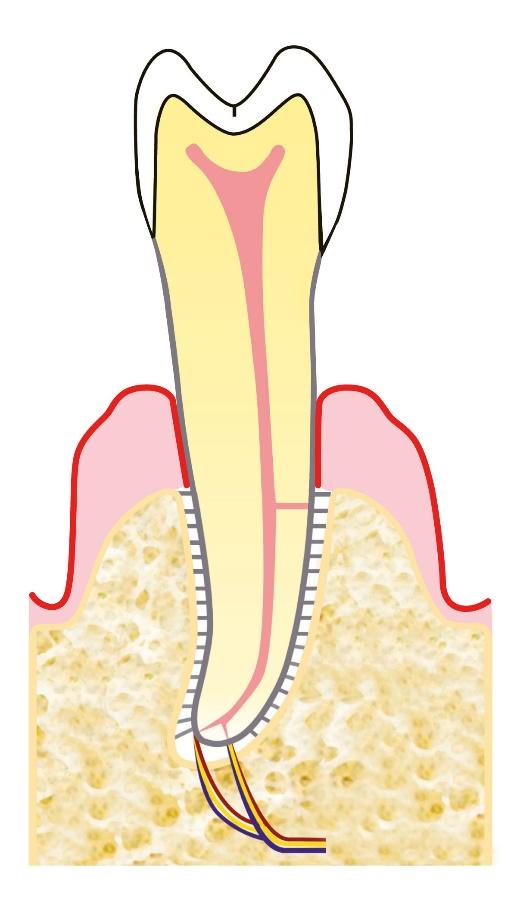 L effettivo sostegno del dente inizia da dove l osso è sano e attaccato alla radice (quadrato tratteggiato). A destra.