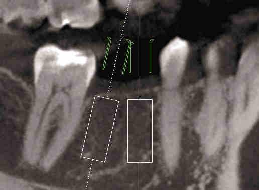 una traiettoria di perforazione troppo vicina al dente adiacente. Il manicotto e la fresa finale colliderebbero con il dente adiacente.