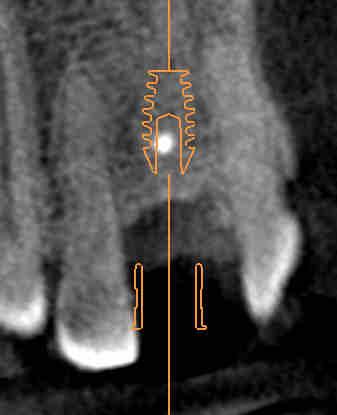 6. Prevenire errori di pianificazione Collisione del manicotto con il dente adiacente La figura 3 mostra la collisione di un manicotto con il dente adiacente.