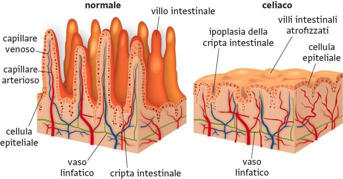 A quel tempo i pazienti da diagnosticare presentavano, da un punto di vista istopatologico, una mucosa