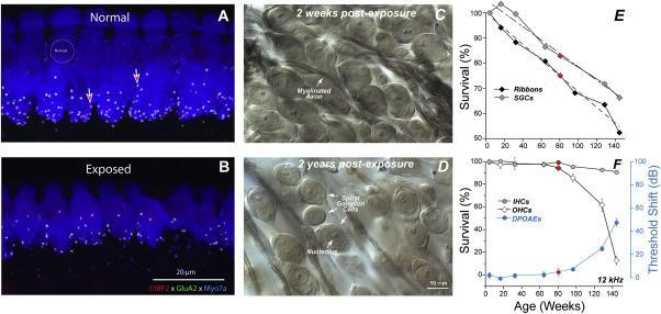 Riduzioni di funzione del nervo acustico Dopo trauma da rumore moderato anche se le cellule ciliate