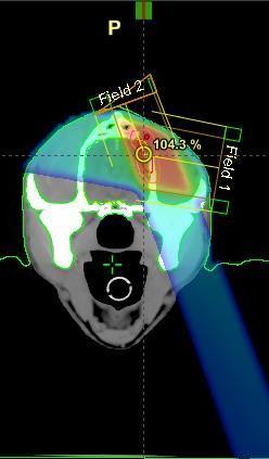 Radioterapia Il nostro acceleratore lineare può generare