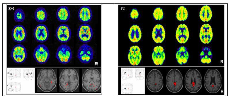 Pazienti RF e FC Metabolismo cerebrale con FDG PET Frisoni, Galluzzi et al.
