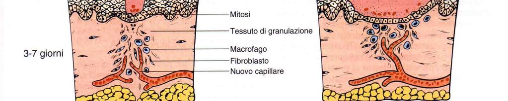 Fattori locali: Infezioni; Caratteristiche della lesione (tipo,