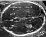 Piano transventricolare - porzione anteriore e posteriore dei ventricoli laterali - cavo setto pellucido : cavità contenente liquido compresa tra due sottili membrane le quali si