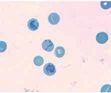 Volume Neociti RMI = Reticulocyte Maturity Index Nei diversi studi è usato come: intensità media di tutta la popolazione reticolocitaria Normociti Gerociti Sferociti reticolociti ad elevata