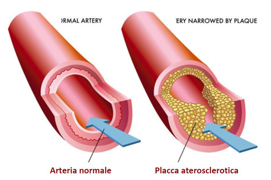 Aterosclerosi: patologia degenerativa, importante causa di malattia e morte nei paesi occidentali, che comporta la presenza di ateromi nelle arterie di grande e medio calibro, ovvero di placche la