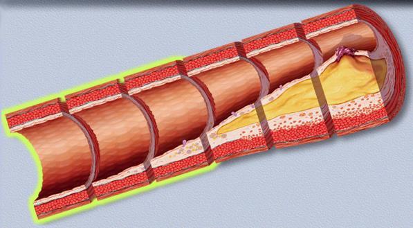 dell'aterosclerosi si chiama ateroma: massa o placca di