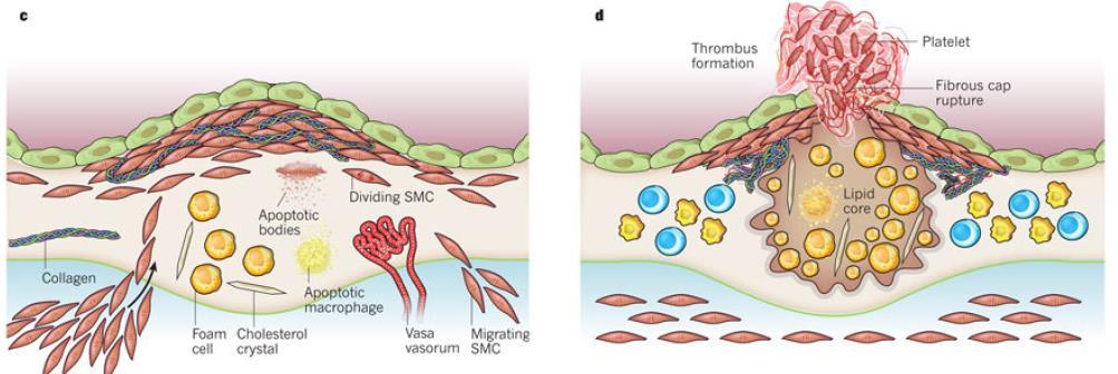 Presenza di un CORE LIPIDICO formato da cellule schiumose morte e lisate, depositi di grasso e materiale fibroso.