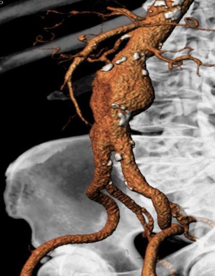 CONSENSO INFORMATO TRATTAMENTO CHIRURGICO/ENDOVASCOLARE DEGLI ANEURISMI DELL AORTA ADDOMINALE (AAA) Gentile Signore/a Lei è affetto/a da aneurisma dell aorta addominale.