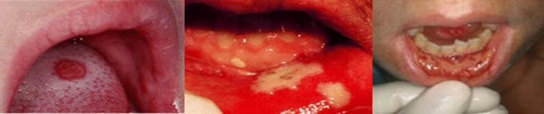 Consigli per la gestione della stomatite La gestione della mucosite del cavo orale prevede: supporto nutrizionale controllo del dolore decontaminazione del cavo orale palliazione della secchezza