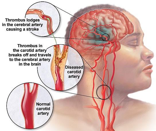 A livello delle arterie questo si traduce in un maggior rischio di formazione di formazione di placche ateroschelotiche (lesioni a carattere flogistico delle pareti