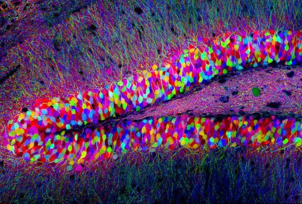 E' probabile che l'ipercortisolemia abbia effetti citotossici.