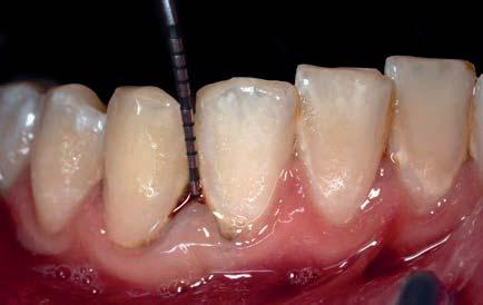 È stato aggiunto alla terapia meccanica un collutorio con clorexidina allo 0,20% due volte al dì come supporto chimico per il controllo