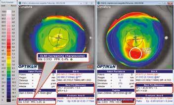 MAPPE ALTIMETRICHE (SPHERICAL OFF-SET) ELEVAZIONI, 3D Le altimetrie di tutti i punti della cornea sono rappresentabili rispetto ad una sfera di