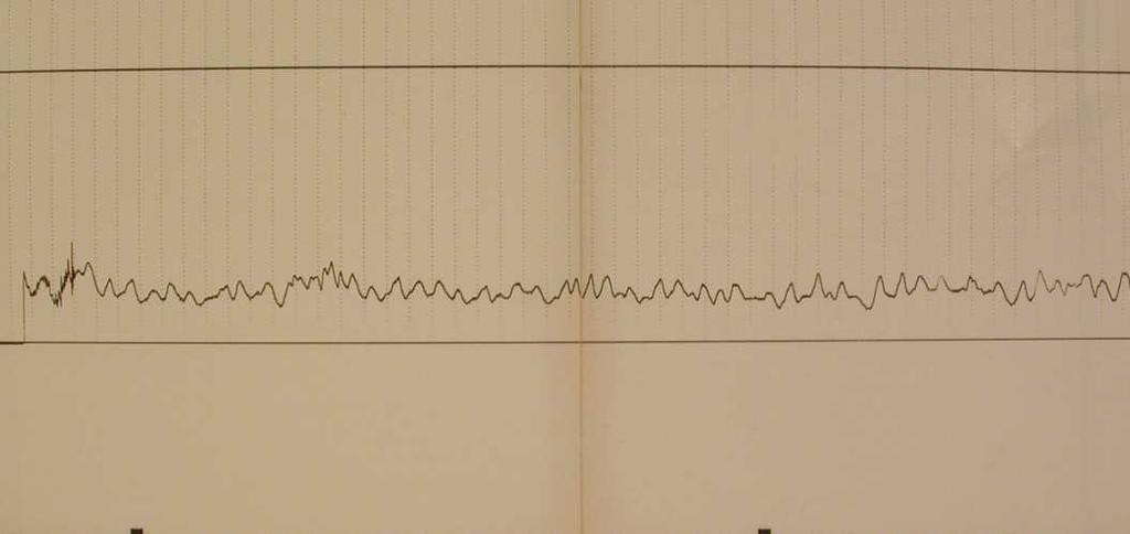 variazioni di pressione durante il battito cardiaco (onde