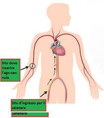 Gli scopi principali dell ablazione sono : il ripristino del ritmo sinusale eliminazione o riduzione dei sintomi (es cardiopalmo,formazione dei trombi