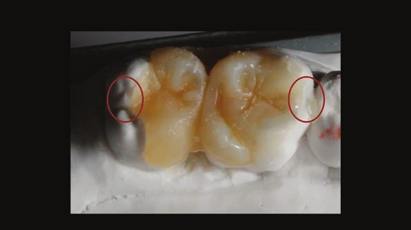 riposizioniamo il THP con il silicone e il composito sul modello fino a quando la mascherina chiuda perfettamente; poi fissiamo la mascherina con