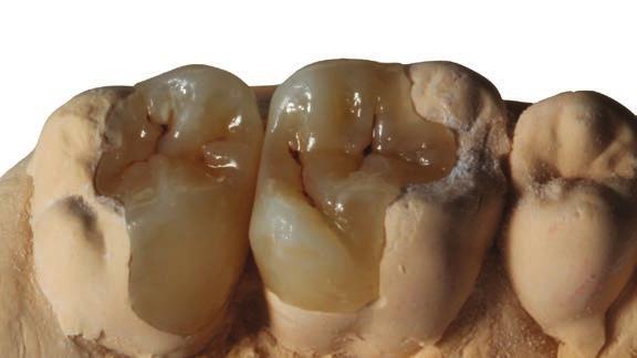 togliere l eccesso di sealcoat con un pennellino asciutto o con un microbrush; 4. fotopolimerizzare con luce idonea (350-500 nm) per 8 minuti; 5. al termine dell operazione n.