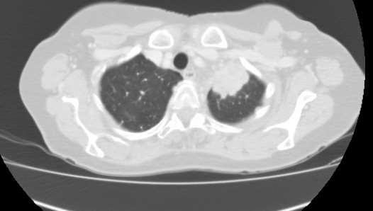 Ricovero in Pneumologia: -TC total body con mdc: lesione LSS 5 cm. Falda di versamento pleurico sx. Linfonodi patologici mediastinici. Lesione litica di L1.