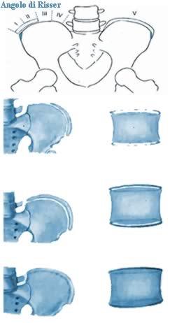 Risser 0 = non è presente il nucleo di ossificazione sulla cresta iliaca; Risser 1+ = iniziale presenza del nucleo con copertura di 1/4 della cresta iliaca; Risser 2+ = copertura di 2/4 della cresta