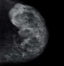 Immagini dei tessuti fino alla parete toracica I detettori specifici per mammografia, disponibili nelle