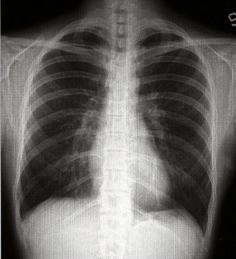 4 3. PROIEZIONI STANDARD TORACE PROIEZIONE POSTERO-ANTERIORE INDICAZIONI= dolore toracico; difficoltà respiratoria; ricerca di addensamenti parenchimali, versamenti pleurici; problemi