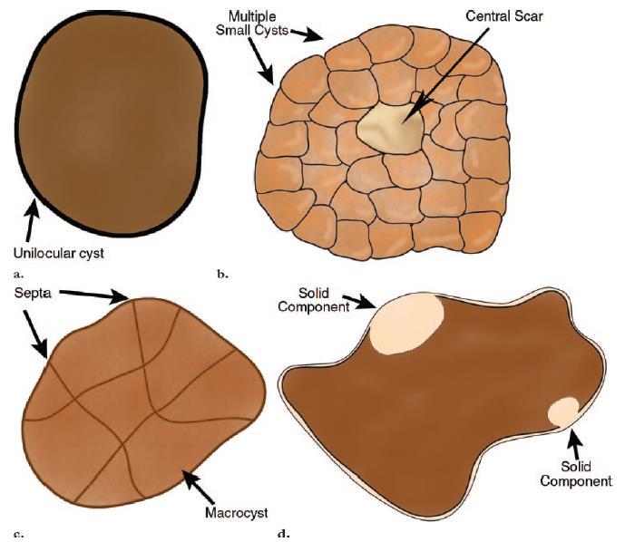 Pseudocyst, IPMN, Serous cystadenoma Epithelial cysts Serous Cystadenoma Mucinous cyst adenoma IPMN