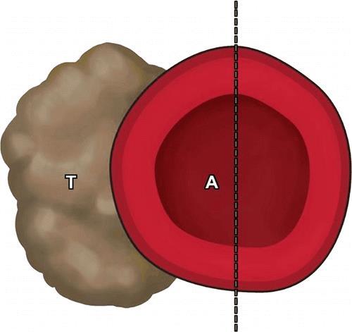 INFILTRAZIONE ARTERIOSA: Quando?