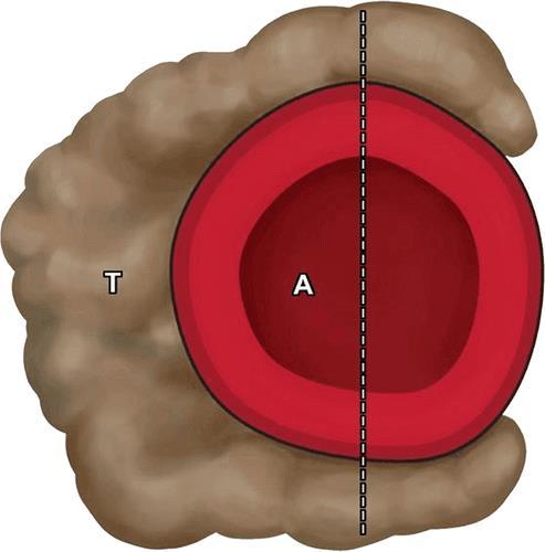 irregolarità del contorno Coinvolgimento dei