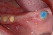 patologie al dente antistante (il 7 ), pur non essendo indispensabile alla masticazione, NON DEVE ESSERE ESTRATTO (potrebbe essere utile in futuro).