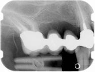 A sinistra. Un sorriso per evidenziare la assoluta non visibilità degli attacchi estetici mascherati internamente. A destra.