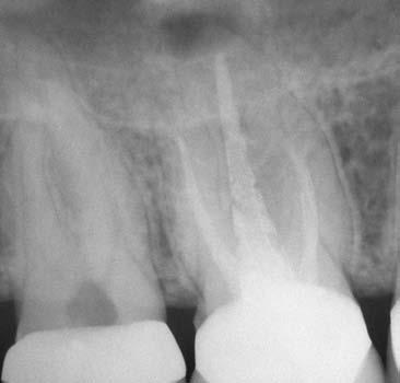I ritrattamenti endodontici ortogradi Clifford J.