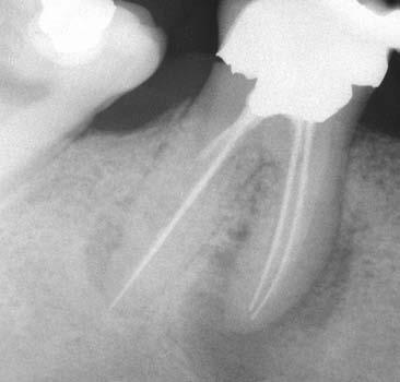 Inoltre, l esplosione di nuove tecnologie, di nuovi strumenti, di nuovi materiali e di nuove tecniche ha favorito lo straordinario cambiamento che si sta verificando nel campo dell endodonzia.