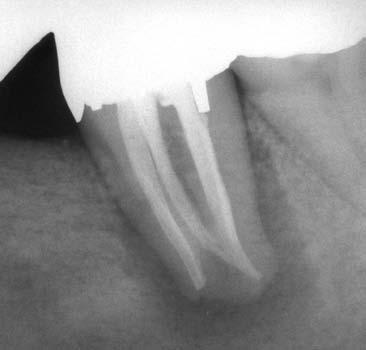 essere trattati endodonticamente o che rappresentano dei fallimenti endodontici.