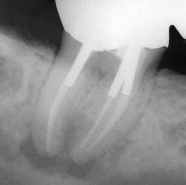 L Informatore Endodontico Vol.2, Nr.4 una lesione di origine endodontica, si deve decidere se estrarre il dente o reintervenire endodonticamente. Oggi il successo in endodonzia si avvicina al 100%.