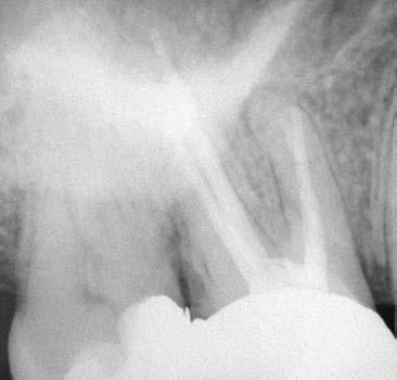 I ritrattamenti endodontici ortogradi Figura 13a La radiografia preoperatoria, angolata in direzione distale, di un primo molare superiore rivela la presenza di un evidente trasporto apicale a