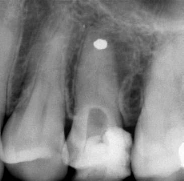 L Informatore Endodontico Vol.2, Nr.