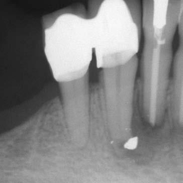 ed otturato nelle sue tre dimensioni. 4. Valutazioni protesiche E fondamentale che al trattamento endodontico faccia seguito un restauro valido sia dal punto di vista estetico che funzionale.
