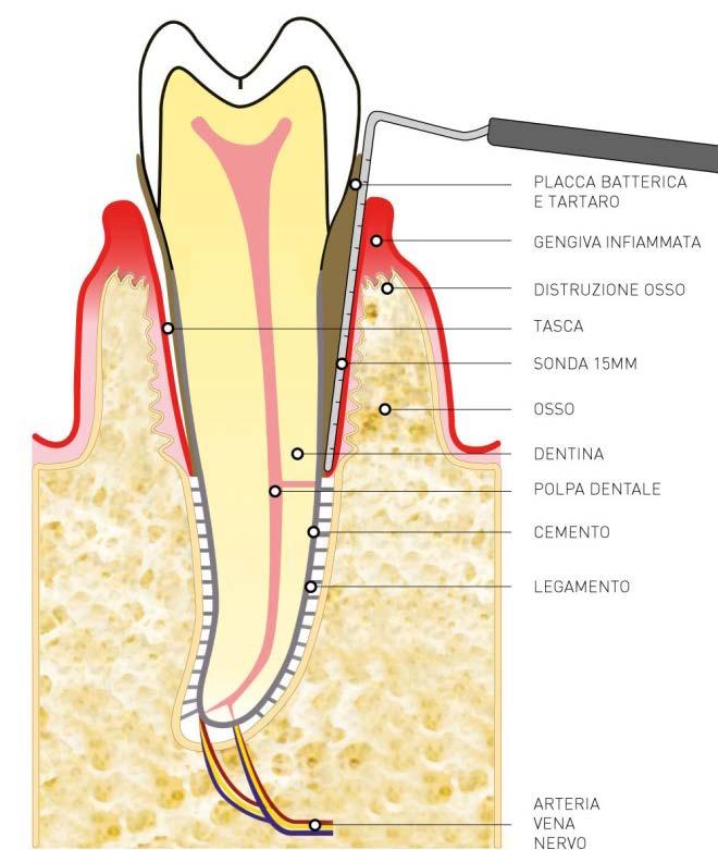 PDF 5. Estetica protesica riabilitativa in pazienti con denti in condizioni limite ( lunghissimi a causa della distruzione ossea causata dalle tasche infraossee della Parodontite avanzata).