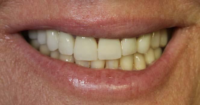 Sinistra. Dopo. Sorriso estetico e possibilità di nutrirsi grazie a denti stabili.