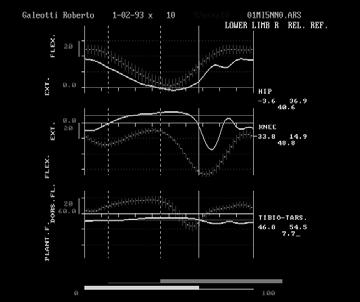 21/3/7 Lower limb joints kinematics Lower limb joints moments Hip joint always in slight extension Normative patient Almost no moment at the