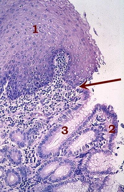 Giunzione gastroesofagea (GGE) 1) Epitelio squamoso