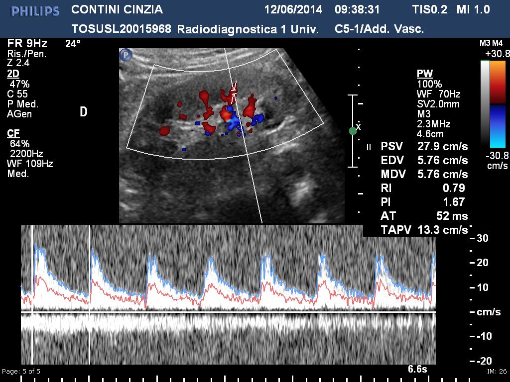 Ecocolor-doppler addominale: Non segni