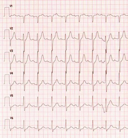 tachicardia sinusale, FC 100