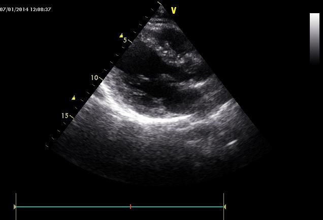 Ecocolordoppler cardiaco: bulbo aortico sclerotico di dimensioni nella norma, con aorta ascendente ai limiti della norma.