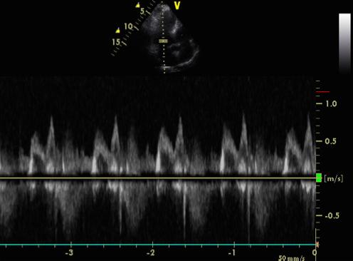 Ipertrofia ventricolare sinistra di tipo concentrico (LVMI 141 g/mq, LVMI/h 65, RWT 0.49).